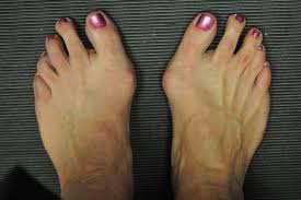 Bunion case study 2
